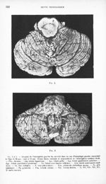 Fig. 1 et 2. Atrophie de l'hémisphère gauche du cervelet dans un cas d'hémiplégie gauche remontant à [...]