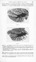 Fig. 3 et 4. Coupe sagittale des hémisphères cérébelleux, dans un cas d'hémiplégie droite, remontant [...]