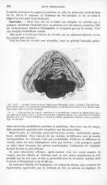 Fig. 5 et 6. Atrophie croisée du cervelet dans un cas d'hémiplégie droite, survenue à l'âge de 78 an [...]
