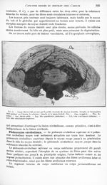 Fig. 6. Coupe du cervelet passant par la partie moyenne des noyaux dentelés. Atrophie de l'hémisphèr [...]