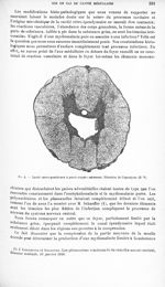 Fig. 3. Cavité centro-postérieure à parois coupées nettement. Dilatation de l'épendyme (D. V) - Revu [...]