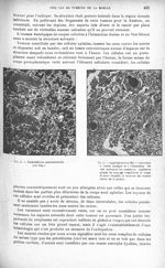 Fig. 4. Endothéliome psammomateux (cas Dap.) / Fig. 5. Angiolipome (cas Mar). Coloration à l'acide o [...]