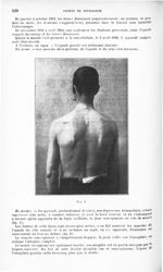 Fig. 1. [Paralysie du nerf sus-scapulaire] - Revue neurologique