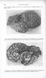 Fig. 1. [Contribution à l'étude de l'aphasie chez les gauchers et des dégénérations du corps calleux [...]