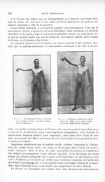 Fig. 2. Mouvement de flexion volontaire de la main à droite : syncinésie contra-latérale identique / [...]