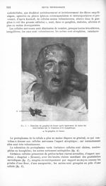 Fig. 1. Résection du ganglion de Gasser après épuisement de toutes les interventions sur le trijumea [...]