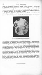 Fig. 5. Concrétions calcaires de formes variées - Revue neurologique