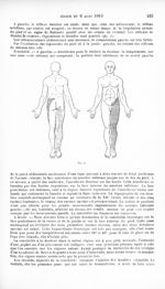 Fig. 1. [Syndrome de Brown-Séquard, type inférieur] - Revue neurologique