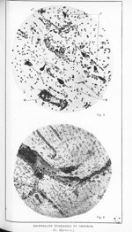 Fig. 3 et 4. Encéphalite épidémique et grossesse (G. Marinesco) - Revue neurologique