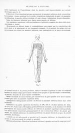 Fig. 1. [Syndrome de Brown-Séquard par coup de couteau, lésion de la moelle cervico-dorsale. Aréflex [...]