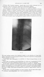 Fig. 1. [Le syndrome de Claude Bernard-Horner dans les lésions médullaires basses avec dissociation  [...]