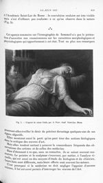 Fig. 5. L'agonie de sainte Cécile, par A. Pozzi. Acad. Saint-Luc, Rome - Revue neurologique