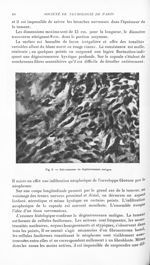 Fig. 3. Schwannome en dégénérescence maligne - Revue neurologique