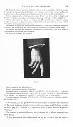 Fig. 1. [Aspect de main hypothalamique au cours d'une maladie de parkinson d'origine encéphalitique] [...]