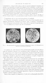 Fig. 3. Microphotographies des sections de la tumeur extradurale de la malade J. M. Méningloblastome [...]