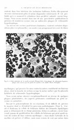Fig. 8. Filet radiculaire de la moelle cervicale (Weigert-Pal). Cinq plaques de schwannite hypertrop [...]