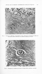 Fig. 5. Lésion par « infiltration » du parenchyme nerveux / Fig. 6. Propagation du néoplasme par la  [...]