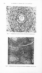 Fig. 7. Propagation par la gaine de Virchow-Robin (Réticulo-lymphosarcome) / Fig. 8. Infiltration d' [...]