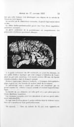 [Un cas de tumeur de la valvule de Vieussens] - Bulletins de la société de pédiatrie de Paris