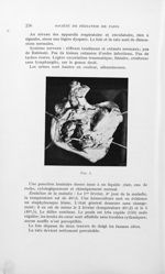 Fig. 1. [Endocardite pariétale staphylococcique du coeur droit] - Bulletins de la société de pédiatr [...]