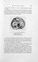 Fig. 1. — Vue de la face auriculaire [Malformation congénitale du coeur chez un nourrisson] - Bullet [...]