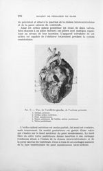 Fig. 2. — Vue, de l’oreillette gauche, de l’osmium Primus [Malformation congénitale du coeur chez un [...]