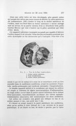 Fig. 3. — Vue de la face ventriculaire [Malformation congénitale du coeur chez un nourrisson] - Bull [...]