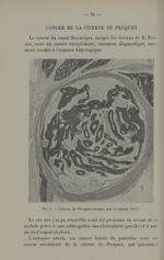 Fig. 8. - Citerne de Pecquet envahie par le cancer (15/1) - Titres et travaux scientifiques du Docte [...]