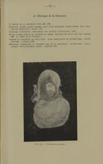 Fig. 30. - Fibrome et grossesse - Notices sur les travaux chirurgicaux
