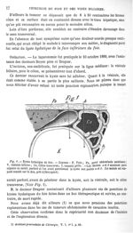 Fig. 1. Kyste hydatique du foie - Quelques opérations sur le foie et les voies biliaires