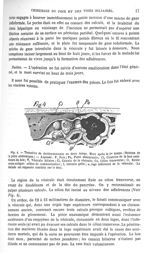 Fig. 4. Tentative de cholécystotomie en deux temps. Mort après le premier temps - Quelques opération [...]