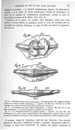 Fig. 10. Cholédochorrhaphie après régularisation des lambeaux formant la poche où se trouvait le cal [...]