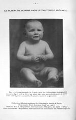 Fig 1 : enfant normale de 8 mois, sœur de l'athrepsique photographié ci-contre et au même âge, sans  [...]