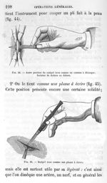 Fig. 44. Autre position du scalpel tenu comme un couteau à découper. Incision de dedans en dehors/ F [...]