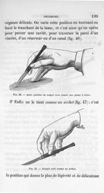 Fig. 46. Autre position du scalpel tenu comme une plume à écrire/ Fig. 47. Scalpel tenu comme un arc [...]
