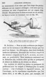 Fig. 48. Autre position du scalpel tenu comme un archet. Incision (a) sur la sonde cannelée d'une ap [...]