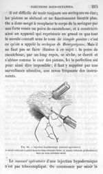 Fig. 60. Injection hypodermique (manuel opératoire) - Leçons de la physiologie opératoire