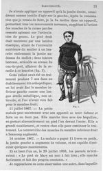 Fig. 1. [Attelles posées sur les deux jambes, dans un cas de paralysie ancienne avec malformations e [...]