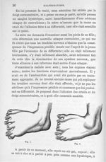 Fig. 7 et 8. [Malformation des pieds : orteils surnuméraires] - Leçons cliniques sur la chirurgie or [...]