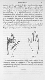 Fig. 9. [Doigt surnuméraire] / Fig. 10. [Main normale après que le doigt surnuméraire a été enlevé]  [...]