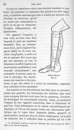 Fig. 30. [Positionnement de l'appareil de Barwell sur la jambe] - Leçons cliniques sur la chirurgie  [...]