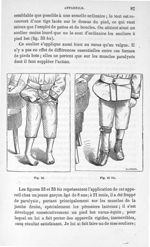 Fig. 33 et 33 bis. [Application du soulier orthopédique sur un pied bot] - Leçons cliniques sur la c [...]
