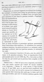 Fig. 37.  [Double pied bot varus congénital guéri] - Leçons cliniques sur la chirurgie orthopédique 