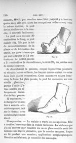 Fig. 52. [Pied bot plantaire] / Fig. 53. [Pied bot guéri] - Leçons cliniques sur la chirurgie orthop [...]