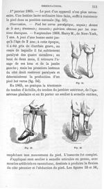 Fig. 54. [Pied bot varus paralytique] / Fig. 55. [Appareil orthopédique adapté au pied] / Fig. 56. [ [...]