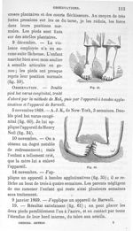 Fig. 59. [Pied bot en voie de guérison] / Fig. 60. [Double pied bot varus congénital] - Leçons clini [...]
