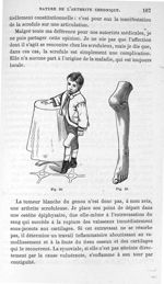 Fig. 98 et 99. [Tumeur blanche du genou (arthrite)] - Leçons cliniques sur la chirurgie orthopédique [...]