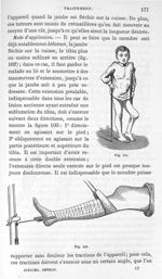 Fig. 102. [Jambe déformée par une arthrite du genou] / Fig. 103. [Installation pour extension de la  [...]