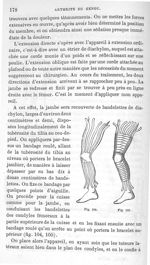 Fig. 104 et 105. [Application de bandelettes sur la jambe avant la pose de l'appareil d'extension] - [...]