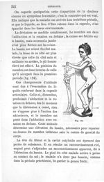 Fig. 124. [Cas de coxalgie] - Leçons cliniques sur la chirurgie orthopédique 